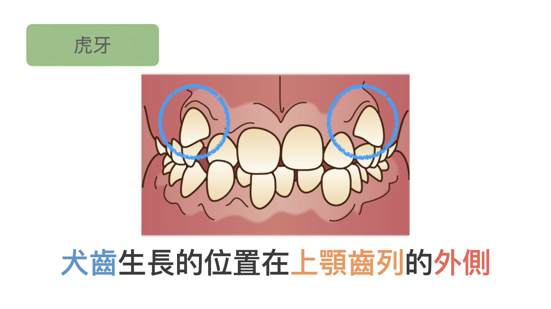 正畸分享｜虎牙埋伏牙 - 知乎