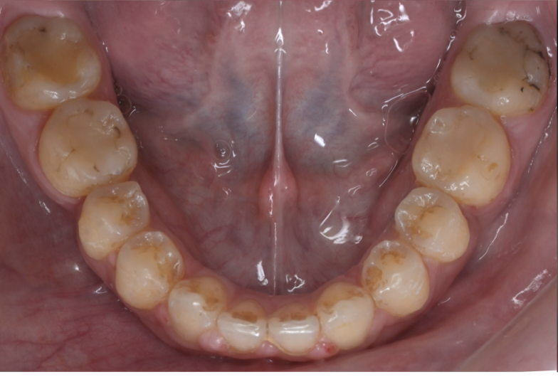 molar missing after treatment